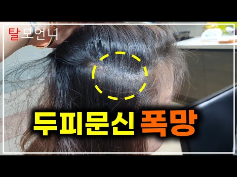 Beware Failed Bad Hair Transplant Smp(Scalp-Micropigmentation) Bad Reviews  - Youtube